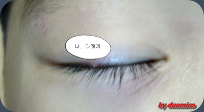 석현 다래끼